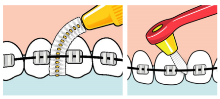 Bilder som visar hur en mellanrumsborste används för att rengöra tänder och tandställning